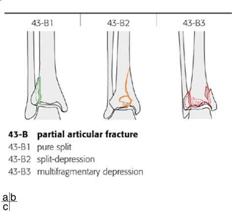 Figure 1 From Distal Tibial Fractures And Pilon Fractures Semantic Scholar