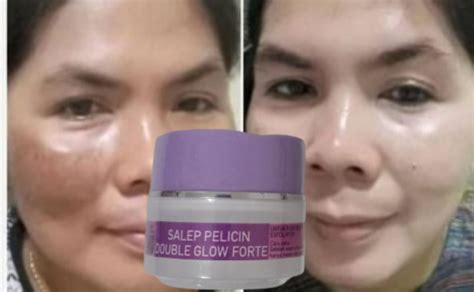 Salep Flek Melasma Cream Flek Hitam Lazada Indonesia