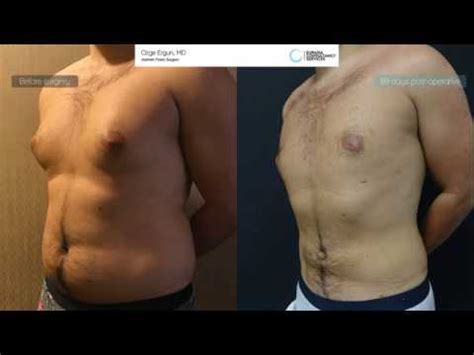 Vaser Liposuction Gynecomastia Surgery Before After Ozge Ergun Md