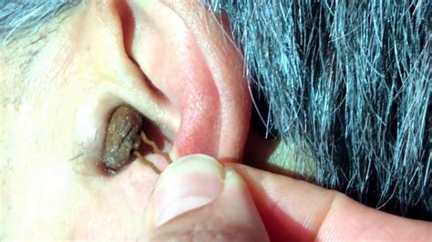 Massive Ear Wax Removal With Bobby Pin How To Remove Ear Wax Youtube