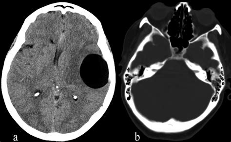 Spontaneous Intraparenchymal Otogenic Pneumocephalus Presenting With