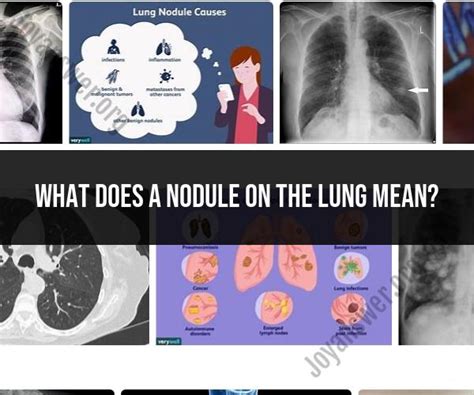 Understanding Lung Nodules: Causes and Implications - JoyAnswer.org