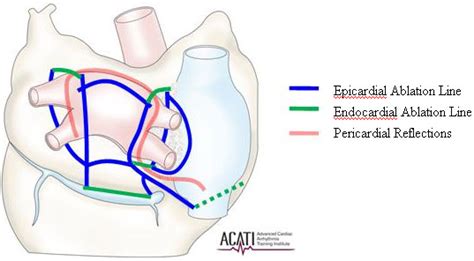 Epicardial Ablation