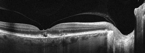 Optical Coherence Tomography, OCT - Retina Doctor Melbourne