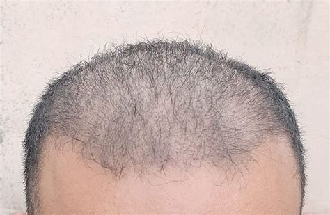 FUE Hair Transplant Los Angeles Patients - Best Hair Transplant