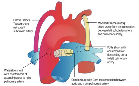 Shunt Sist Mico Pulmonar Conceitos B Sicos