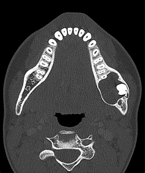 Odontogenic Keratocyst Axial CT Image Shows A Welldefined Expansile