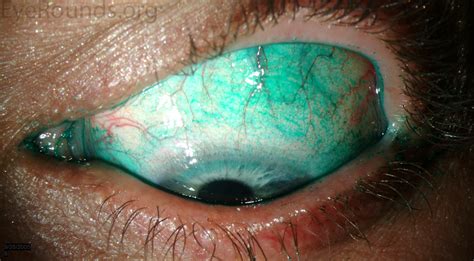 Atlas Entry Lissamine Green Staining In Keratoconjunctivitis Sicca