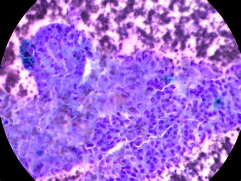 Papillary Carcinoma Of The Thyroid Fna Giemsa Ed Uthman Flickr