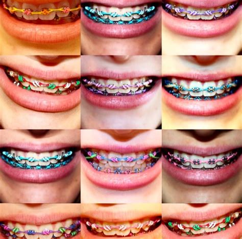 Getting Braces There Is An Art To Picking Out The Colors For You Ortodonti Diş