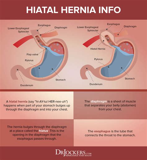 Food Pipe Hiatal Hernia Symptom Doctors Hot Sex Picture