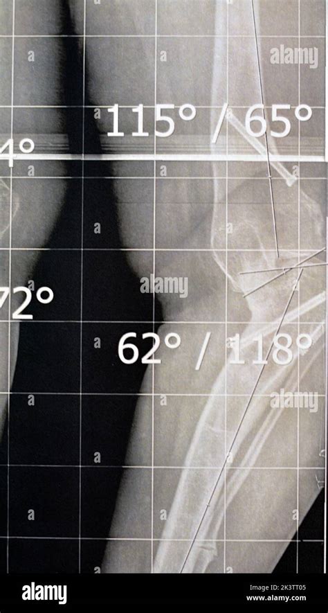 Plain X Ray Long Film Standing Position Showing Both Legs With