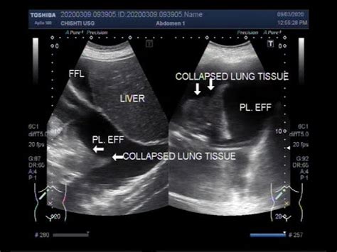 Ascites Vs Pleural Effusion Ultrasound