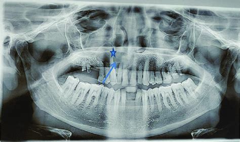 Simple Bone Cyst Mandible