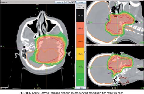 Figure 5 From Two Giant Glomus Jugulare Tumors With Multiple Cranial