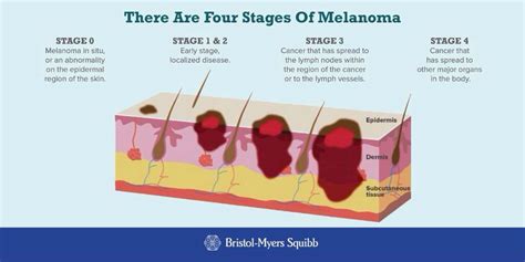 Stages Of Cancer Lymph Node