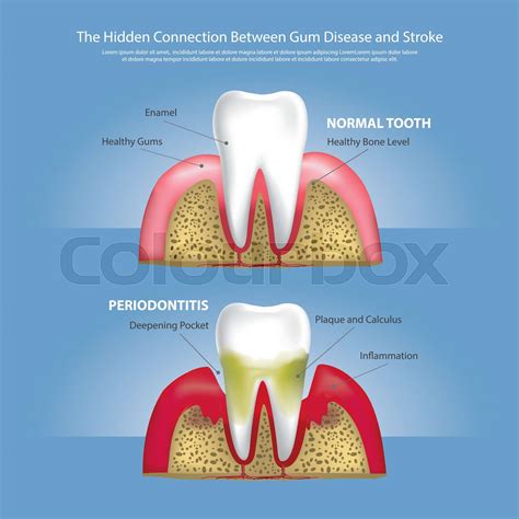 Human Teeth Stages Of Gum Disease Vector Illustration Stock Vector