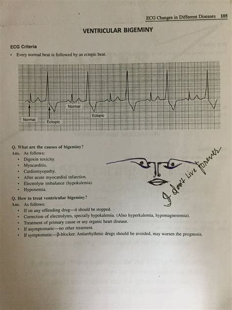 ECG ATRIAL AND VENTRICULAR ECTOPICS