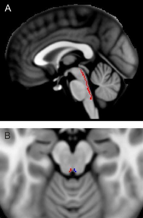 Medial Longitudinal Fasciculus Mri