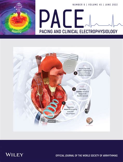 Bridge Pacemaker With An Externalized Active Fixation Lead For