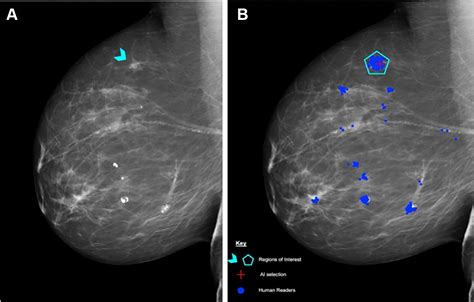 Performance Of A Breast Cancer Detection Ai Algorithm Using The Personal Performance In