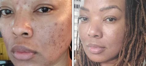 The Ultimate Guide To Chemical Peels For Hyperpigmentation Reveal Your