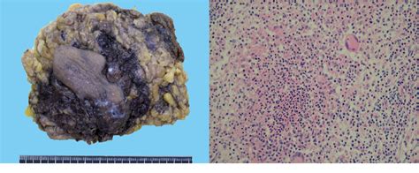 Figure From A Rare Case Of Granulomatous Mastitis In The Accessory