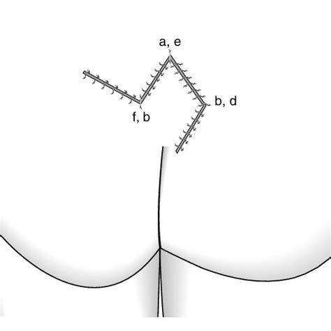 Pdf Limberg Flap Versus Primary Closure In The Treatment Of Primary