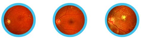 Diabetic Retinopathy Grading Online Course Eye Health Nepal