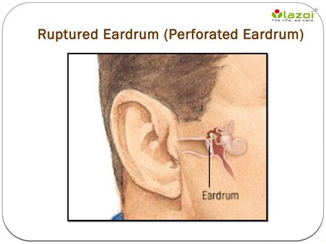 Ruptured eardrum by lazoithelife - Issuu