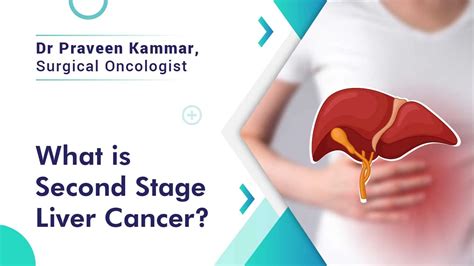 Stage 2 Liver Cancer, Symptoms, Staging and Treatments