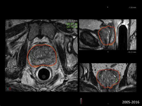 Bending The Slope Of The Brachytherapy Curve Magnetic Resonance