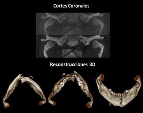 Caso N Traumatismo Mandibular Con Fractura Subcondilar Bilateral