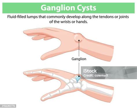 Illustration Of Ganglion Cysts On Hands And Wrists Stock Illustration