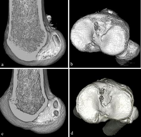 Postoperative Quadriceps Weakness And Male Sex Are Risk Factors For Patellofemoral Articular