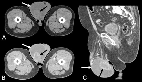 Pelvic Computed Tomography In The Axial A And B And Sagittal C Download Scientific Diagram