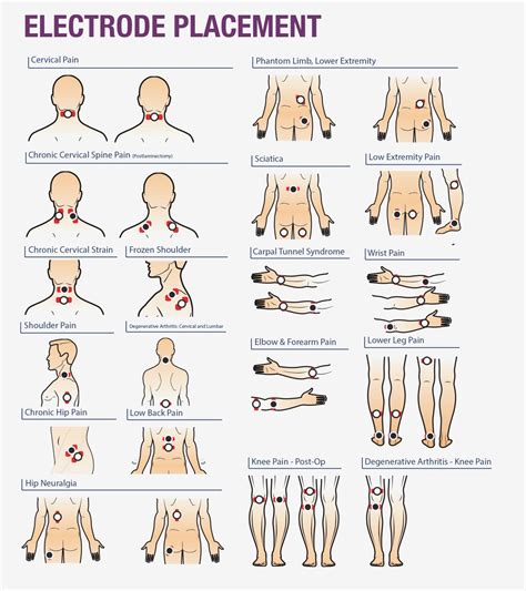 Tens Unit Pad Placement Chart