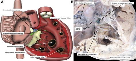 Pdf Classification Of Ventricular Septal Defects For The Eleventh