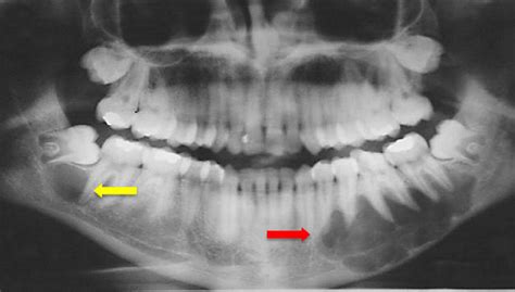 Figure 1 From A Rare Case Of Bilateral Mandibular Simple Bone Cyst And