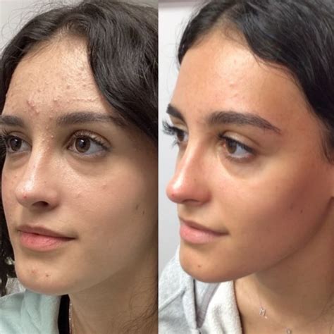 Before And After Skin Glow Dermatology