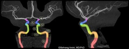 Internal carotid artery | Radiology Reference Article | Radiopaedia.org