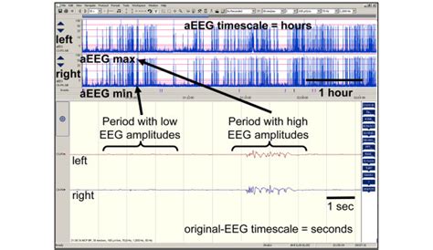 Trend Monitor Displays Original Electroencephalography Eeg And