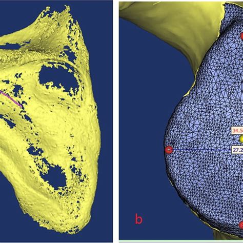 3D reconstruction and glenoid cavity measurement | Download Scientific Diagram