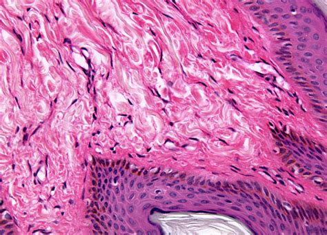 Squamous Cell Papilloma at 20x Magnification | MicroscopyU