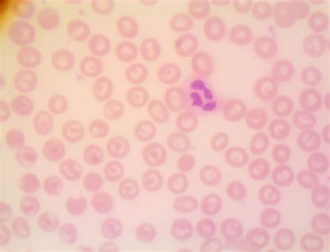 Hematology Photos Flashcards Quizlet