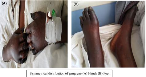 Symmetrical Peripheral Gangrene A Rare Clinical Entity Macheka