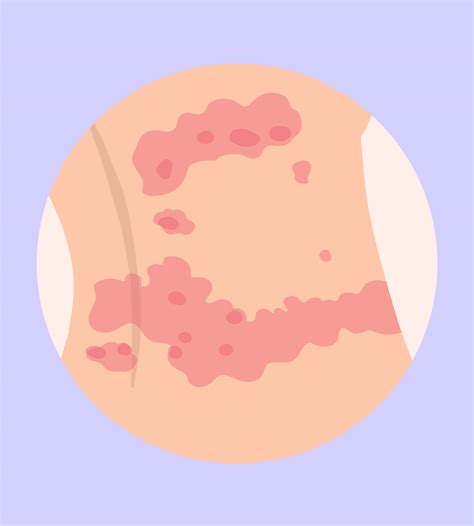 Orticaria: trattamento e causa | Redcare