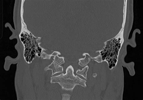 File:Petrous bone trauma - fracture, ossicular dislocation and ...