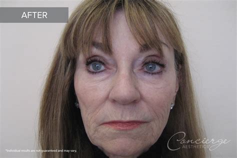 Before And After Juvederm Ultra And Botox 65 Yo Concierge Aesthetics