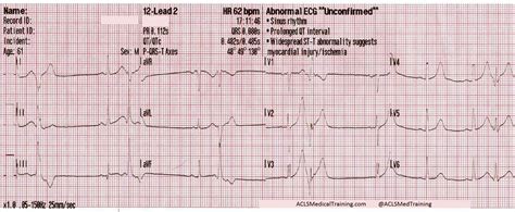 St Segment Elevation Ecg